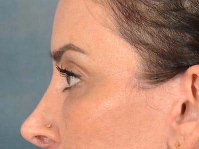 Eyelid Lift Before & After Gallery - Patient 447876 - Image 10