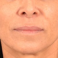 Lip Lift Before & After Gallery - Patient 278200 - Image 1