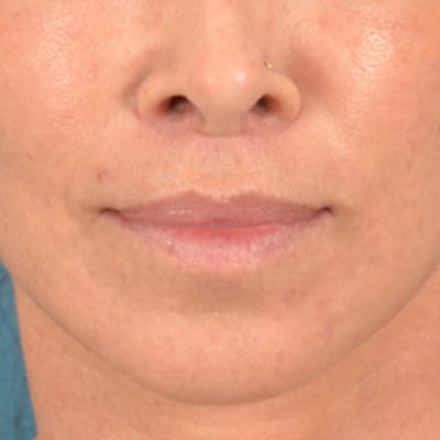 Lip Lift Before & After Gallery - Patient 278200 - Image 2