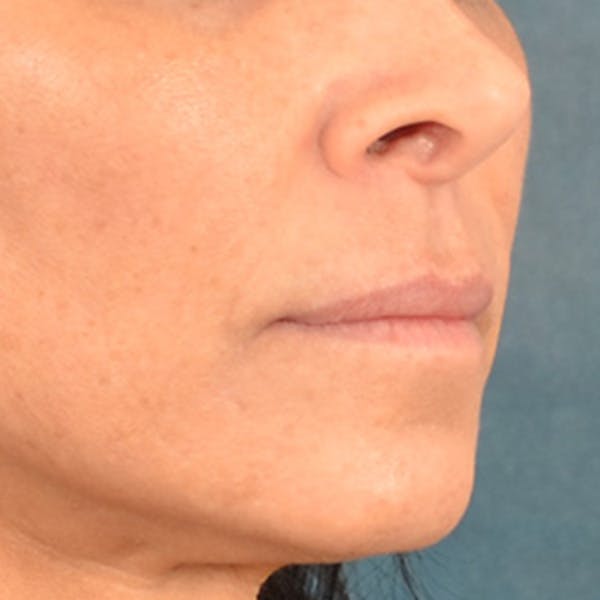 Lip Lift Before & After Gallery - Patient 278200 - Image 3