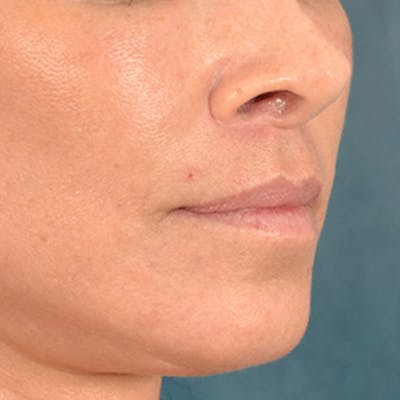 Lip Lift Before & After Gallery - Patient 278200 - Image 4