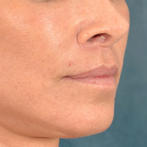 Lip Lift Before & After Gallery - Patient 278200 - Image 4