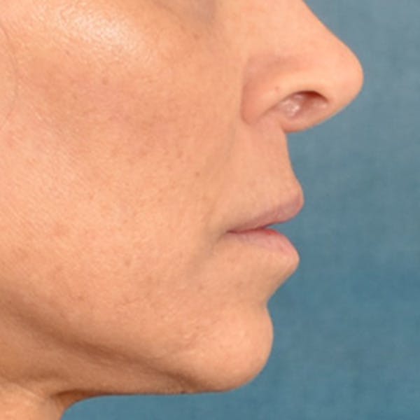 Lip Lift Before & After Gallery - Patient 278200 - Image 5