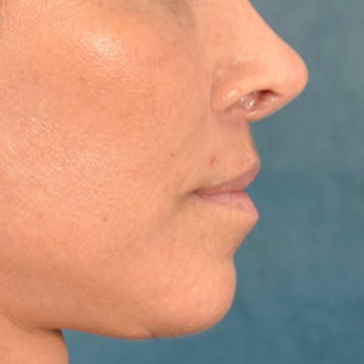 Lip Lift Before & After Gallery - Patient 278200 - Image 6