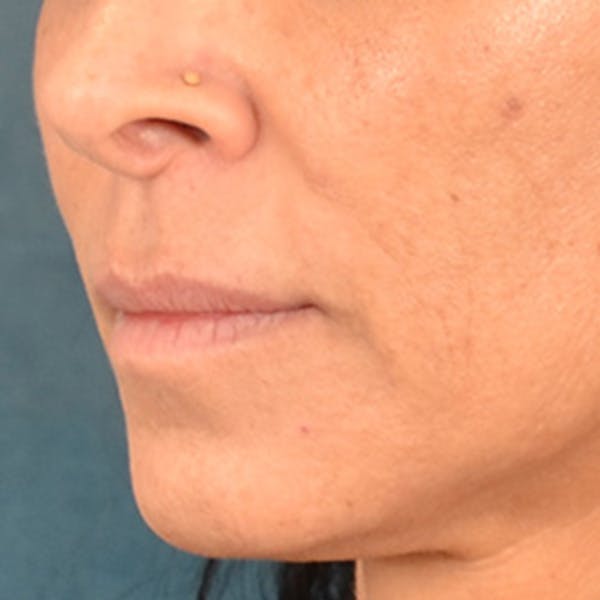 Lip Lift Before & After Gallery - Patient 278200 - Image 7