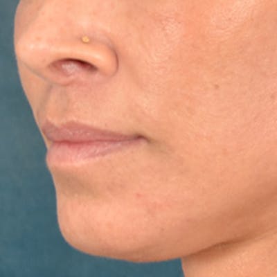 Lip Lift Before & After Gallery - Patient 278200 - Image 8