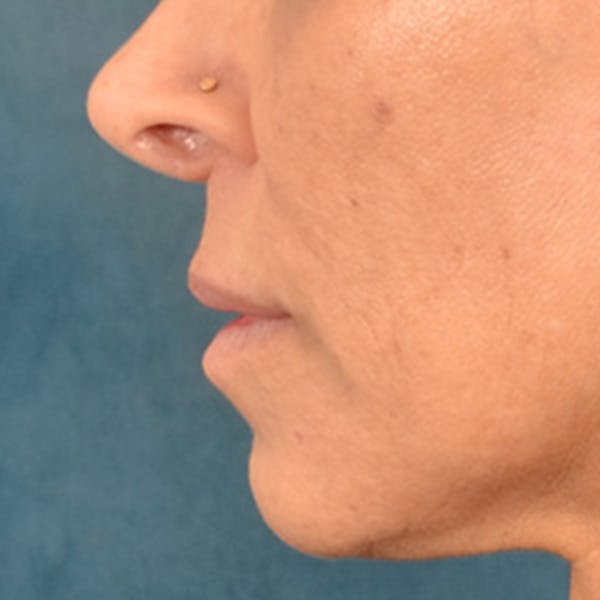 Lip Lift Before & After Gallery - Patient 278200 - Image 9