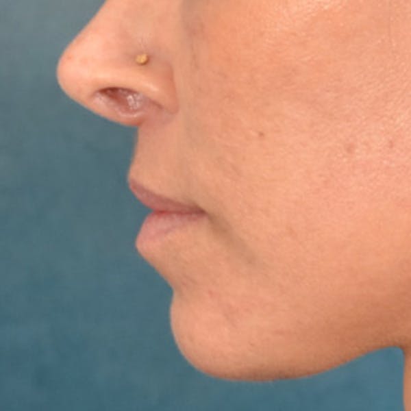 Lip Lift Before & After Gallery - Patient 278200 - Image 10