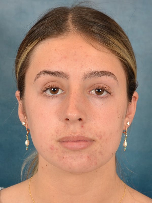 Rhinoplasty Before & After Gallery - Patient 752030 - Image 5