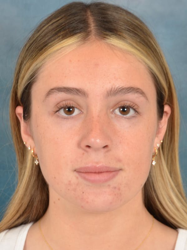 Rhinoplasty Before & After Gallery - Patient 752030 - Image 6