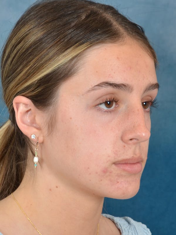Rhinoplasty Before & After Gallery - Patient 752030 - Image 7