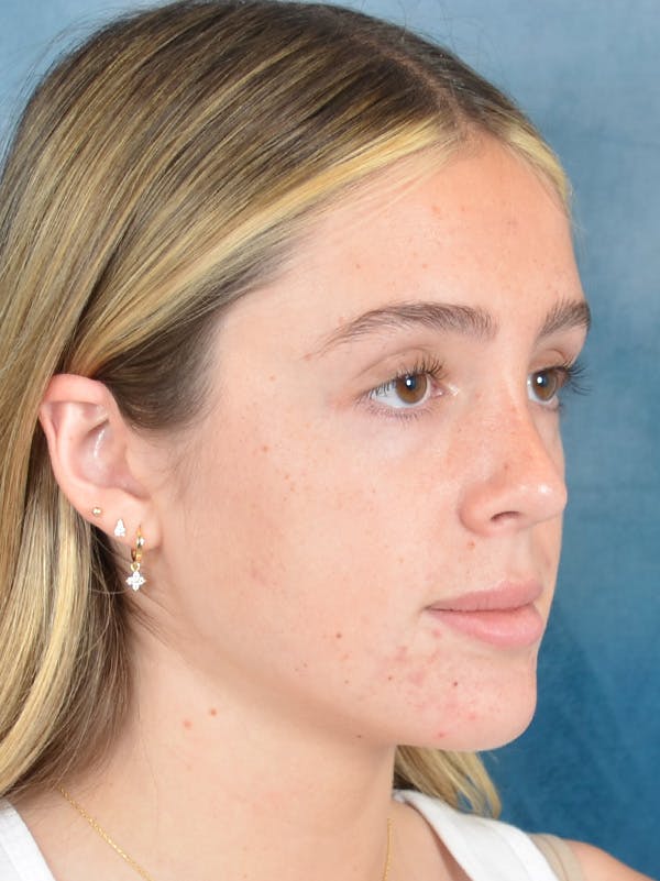 Rhinoplasty Before & After Gallery - Patient 752030 - Image 8