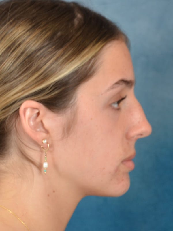 Rhinoplasty Before & After Gallery - Patient 752030 - Image 9