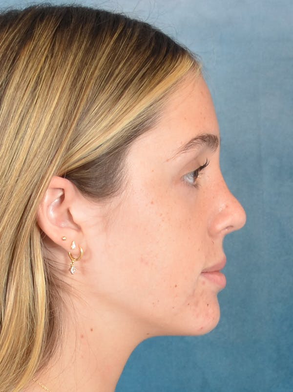 Rhinoplasty Before & After Gallery - Patient 752030 - Image 10