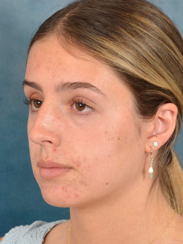 Rhinoplasty Before & After Gallery - Patient 752030 - Image 3