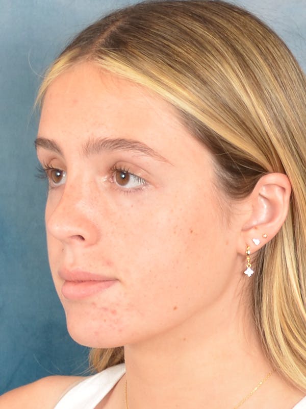 Rhinoplasty Before & After Gallery - Patient 752030 - Image 4