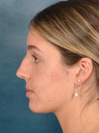 Rhinoplasty Before & After Gallery - Patient 752030 - Image 1