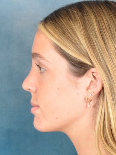 Rhinoplasty Before & After Gallery - Patient 752030 - Image 2