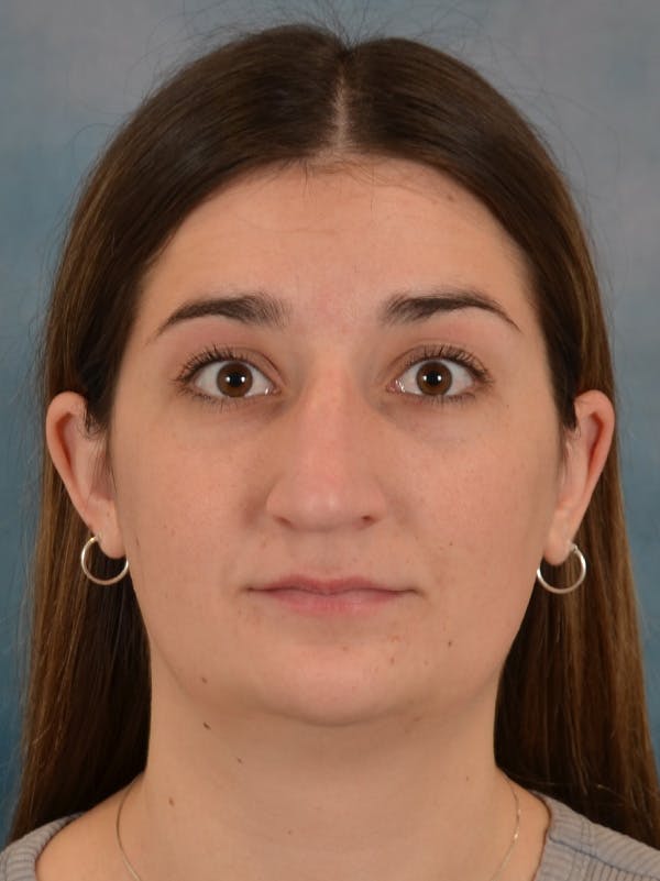 Rhinoplasty Before & After Gallery - Patient 403067 - Image 5