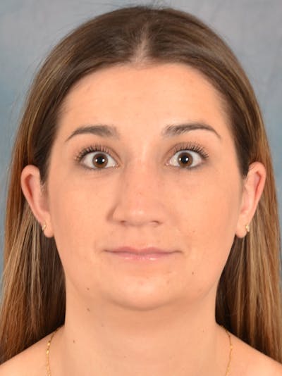 Rhinoplasty Before & After Gallery - Patient 403067 - Image 6