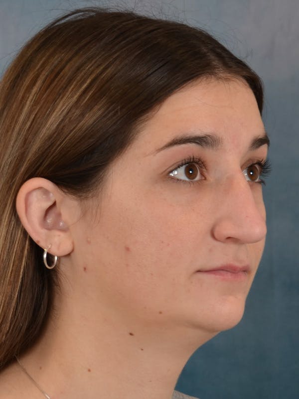 Rhinoplasty Before & After Gallery - Patient 403067 - Image 7