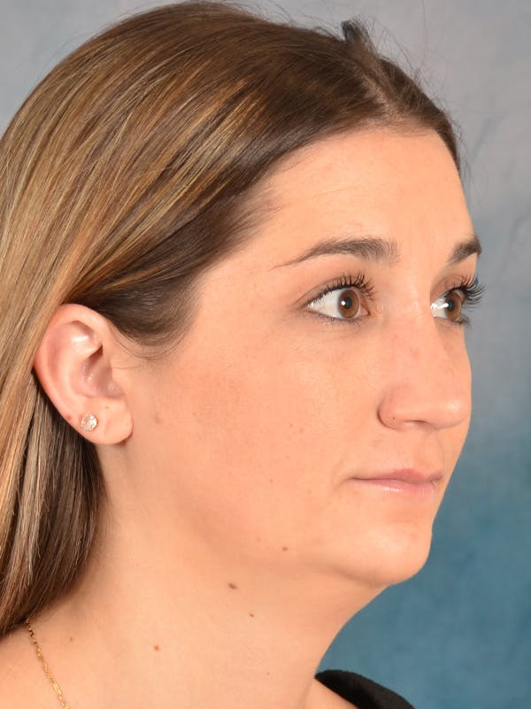 Rhinoplasty Before & After Gallery - Patient 403067 - Image 8
