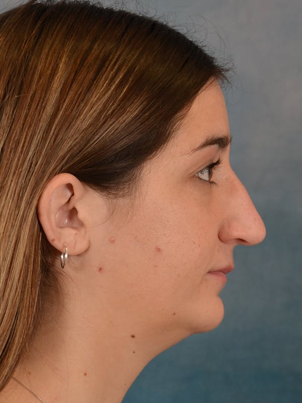 Rhinoplasty Before & After Gallery - Patient 403067 - Image 9