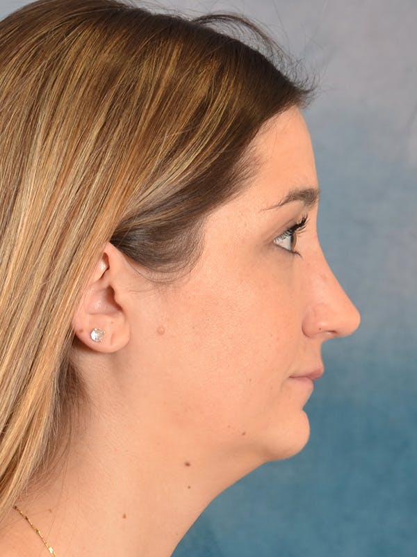 Rhinoplasty Before & After Gallery - Patient 403067 - Image 10