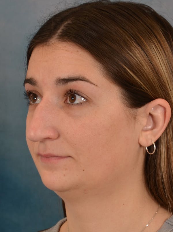 Rhinoplasty Before & After Gallery - Patient 403067 - Image 3