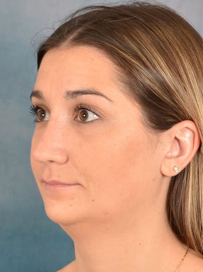 Rhinoplasty Before & After Gallery - Patient 403067 - Image 4