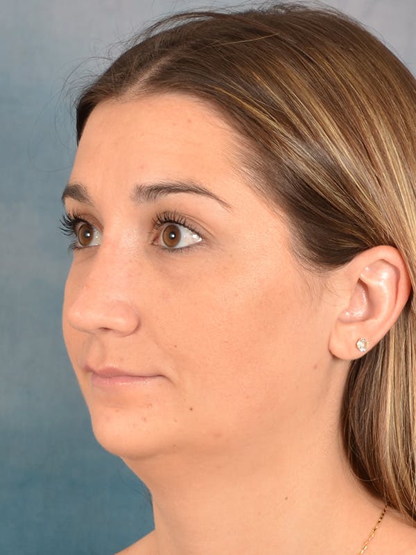 Rhinoplasty Before & After Gallery - Patient 403067 - Image 4
