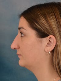 Rhinoplasty Before & After Gallery - Patient 403067 - Image 1