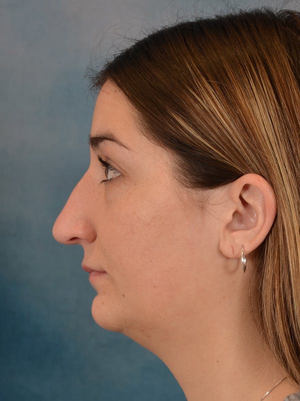 Rhinoplasty Before & After Gallery - Patient 403067 - Image 1