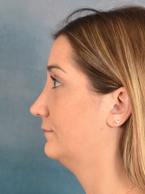 Rhinoplasty Before & After Gallery - Patient 403067 - Image 2