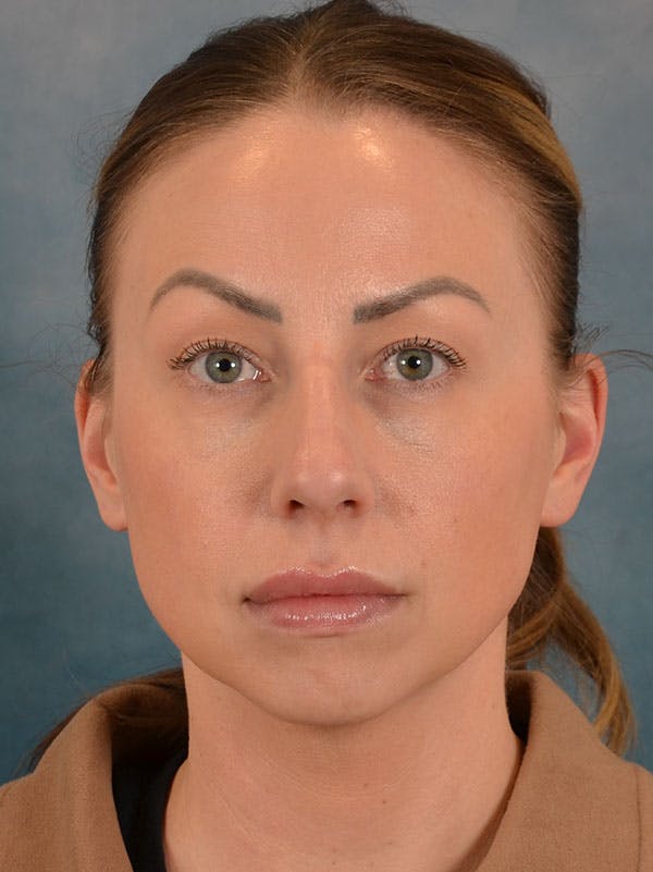 Rhinoplasty Before & After Gallery - Patient 133193 - Image 5
