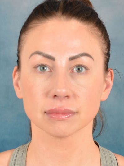 Rhinoplasty Before & After Gallery - Patient 133193 - Image 6