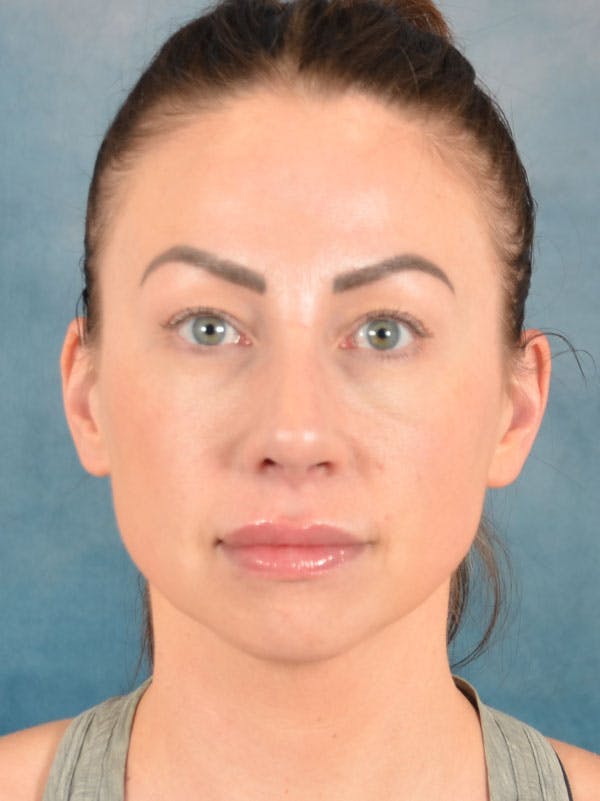 Rhinoplasty Before & After Gallery - Patient 133193 - Image 6