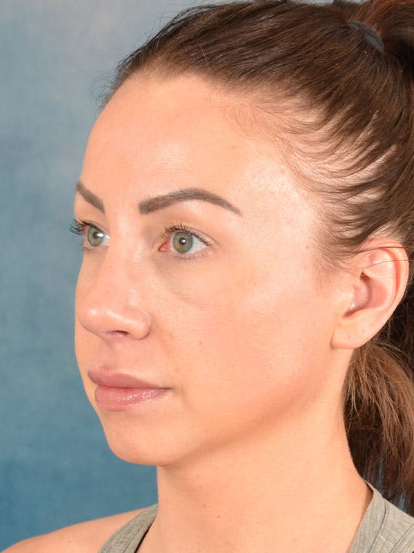 Rhinoplasty Before & After Gallery - Patient 133193 - Image 4