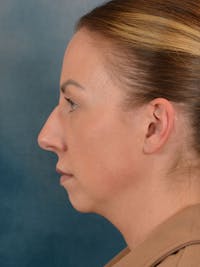 Rhinoplasty Before & After Gallery - Patient 174036 - Image 1