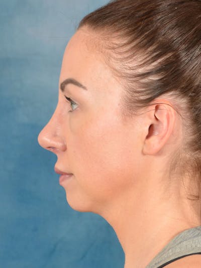 Rhinoplasty Before & After Gallery - Patient 133193 - Image 2