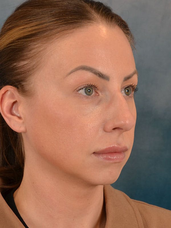 Rhinoplasty Before & After Gallery - Patient 133193 - Image 7
