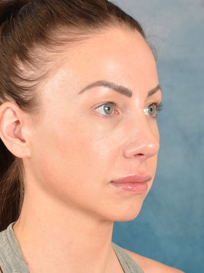 Rhinoplasty Before & After Gallery - Patient 133193 - Image 8