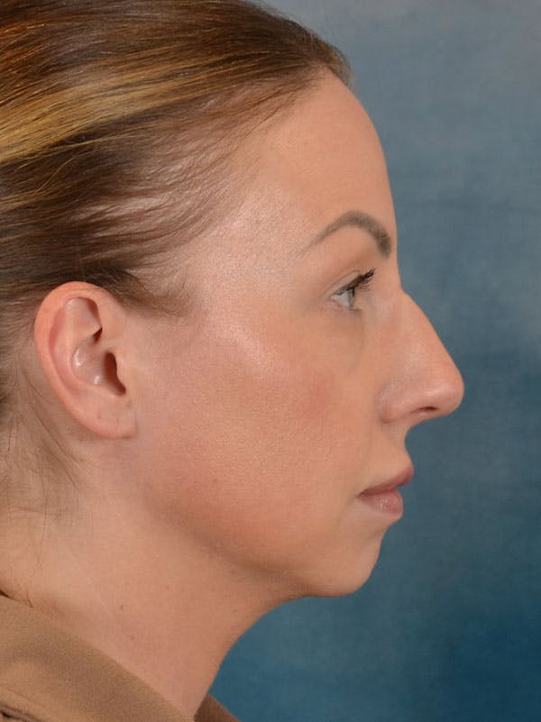 Rhinoplasty Before & After Gallery - Patient 133193 - Image 9