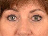 Brow Lift Before & After Gallery - Patient 381914 - Image 1