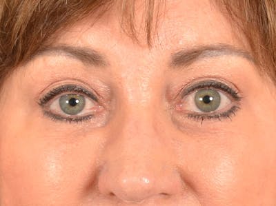 Brow Lift Before & After Gallery - Patient 381914 - Image 2