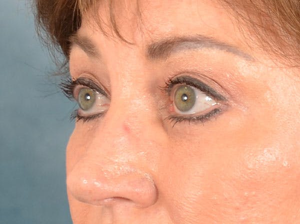 Brow Lift Before & After Gallery - Patient 381914 - Image 4