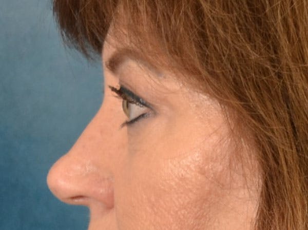 Eyelid Lift Before & After Gallery - Patient 312422 - Image 5