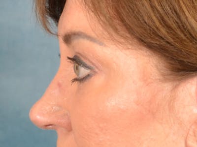 Brow Lift Before & After Gallery - Patient 381914 - Image 6