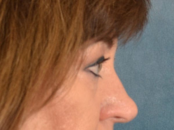 Brow Lift Before & After Gallery - Patient 381914 - Image 7