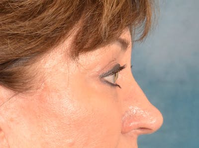 Brow Lift Before & After Gallery - Patient 381914 - Image 8